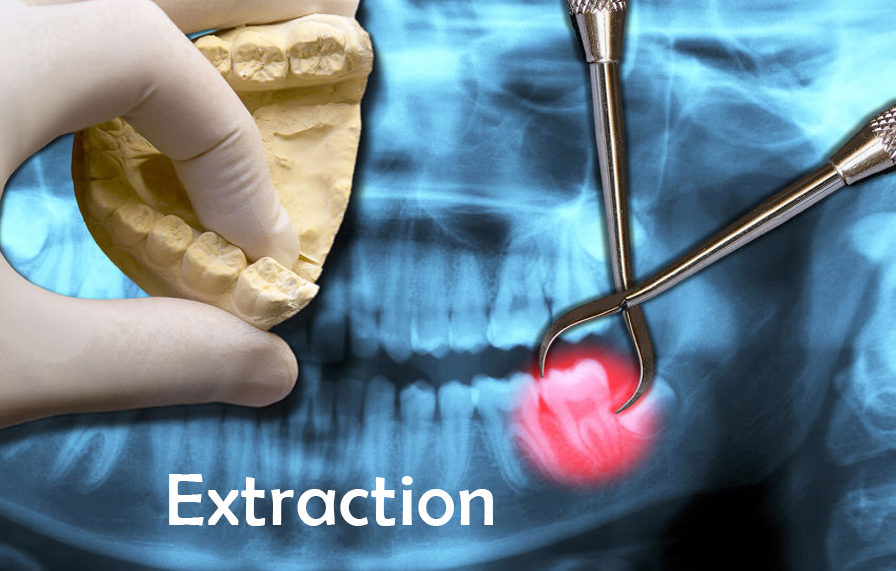Extractions & Socket Preservation Bone Grafting Dr. Homing Kim, DDS